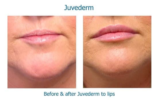 Before and after Juvederm lip augmentation