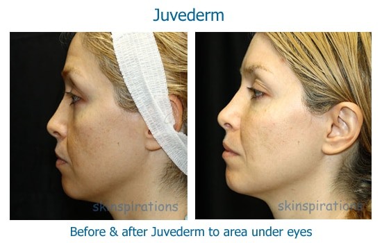 Before and after Juvederm under eyes