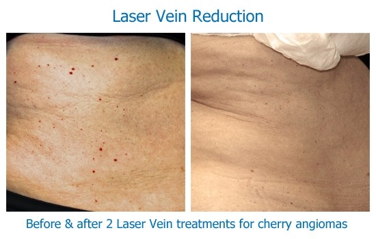 Cherry angioma laser removal results
