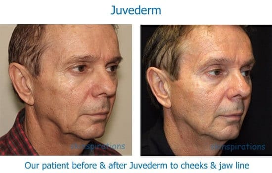 Man before and after dermal filler to cheeks and jawline