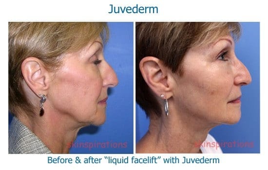 Before and after a liquid facelift with Juvederm