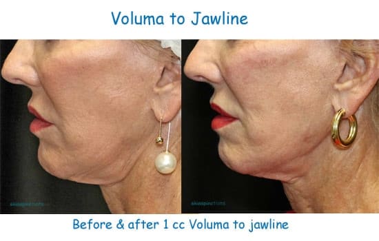 Before and after Voluma to tighten Jawline