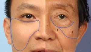 Facial ligaments drawn onto photo of face