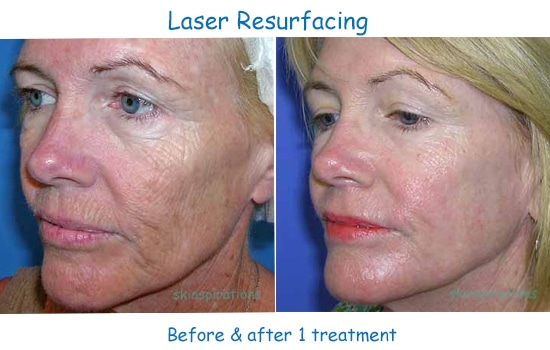 before and after laser skin resurfacing of face