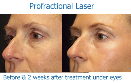 before and after Profractional laser for dark eye circles
