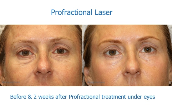 before and after Profractional laser for eye wrinkles