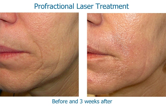 before and after Profractional laser to wrinkles near mouth