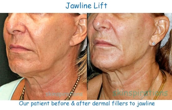 Tighter jawline treatment