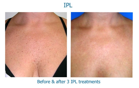 IPL removes spots on the skin as seen on the chest here