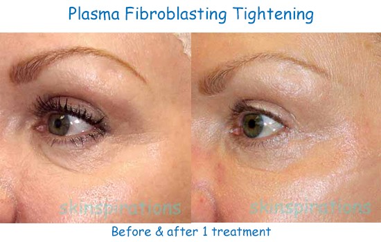 Improvement in eye wrinkles with plasma fibroblasting