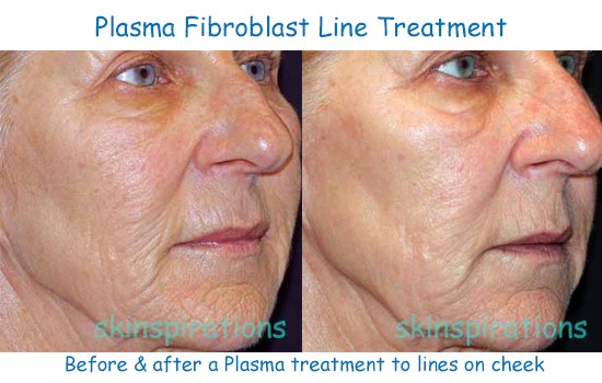 Plasma fibroblasting erases fine lines