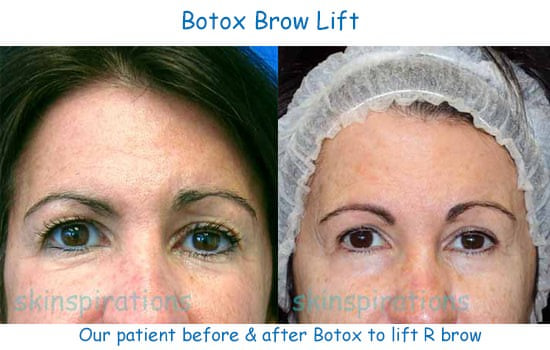Botox can lift brows or make them symmetric