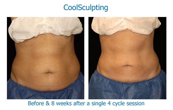 Before and after photos of coolsculpting fat reduction in an abdomen