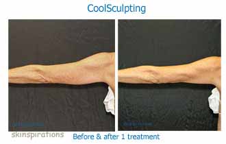 before after photos of results of fat loss in arms with Coolsculpting