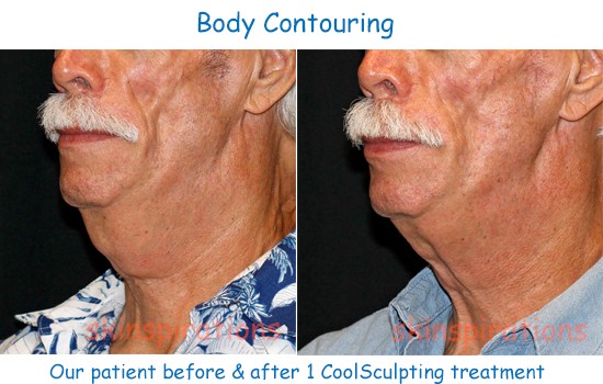 Double chin fat reduction with Coolsculpting