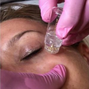 Shows microinfusion skin stamping on face