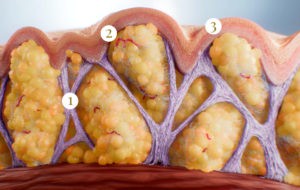 Diagram showing causes of cellulite