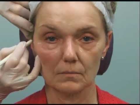 Face Lifting With Dermal Filler Lesson