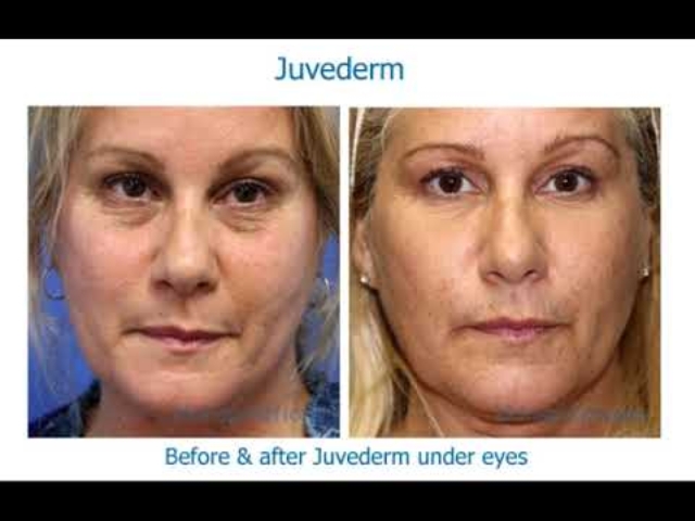 Under-eye circles and shadows can be erased with dermal filler