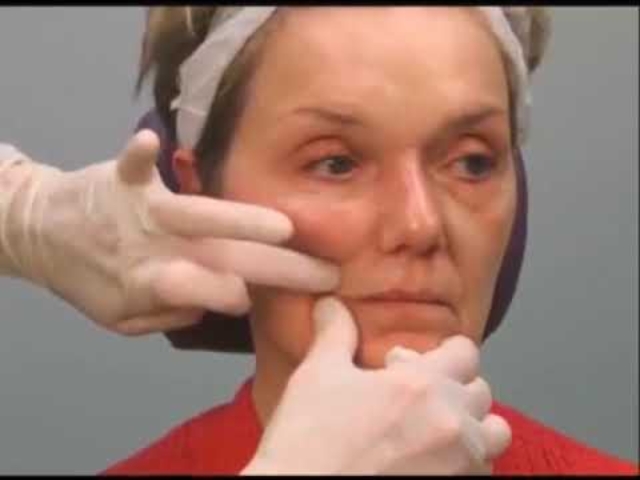 A lesson teaching how to use dermal filler to lift drooping mouth corners