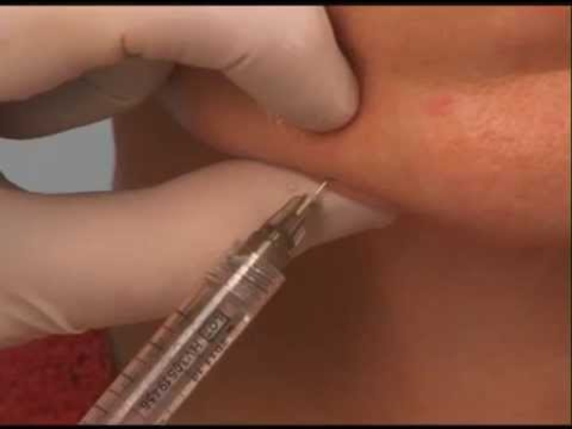 Injecting dermal filler to reduce the look of jowls