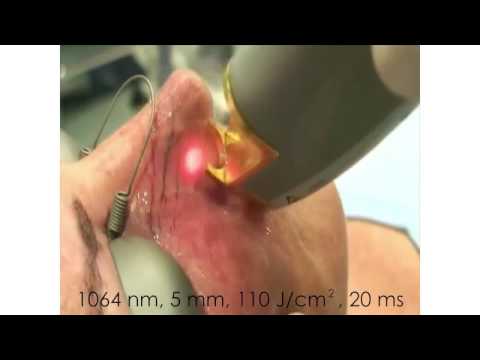 Nose veins removed with a laser