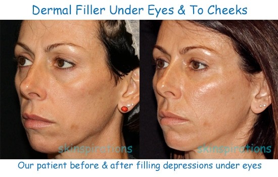 Dermal Fillers And Fat Results