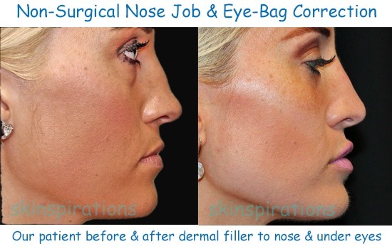 Results of filler to correct nose bump and eye bags