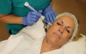 A photo of a Microneedling treatment of the face with the SkinPen
