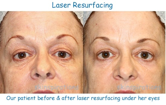 Our Laser Resurfacing, Profractional & Laser Peel Results