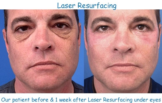 laser resurfacing before after results