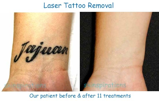 black tattoo before and after laser removal