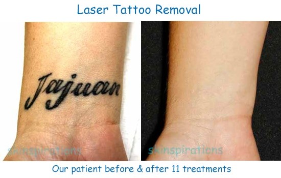 Laser Tattoo Removal Results - Skinspirations