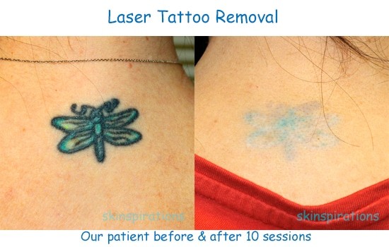 Laser Tattoo Removal Results