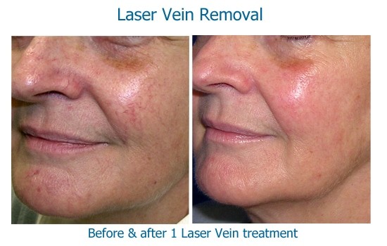 Laser Vein Removal And IPL Results