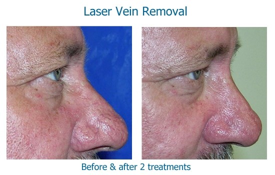 Laser Vein Removal And IPL Results
