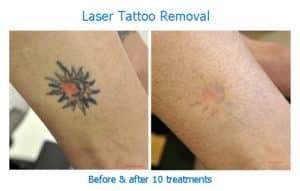 A colored tattoo before and after laser removal