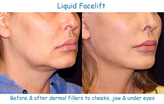 before and after Juvederm to tighten the jawline and lift the face