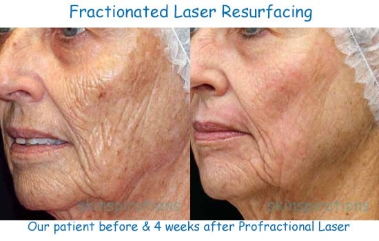 Fractionated ablative laser skin resurfacing wrinkle improvement results at Skinspirations