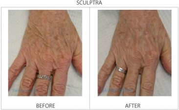 Results of a Sculptra treatment of bony hands at Skinspirations in Clearwater, FL