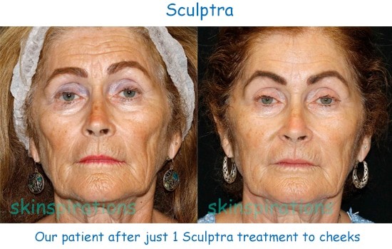 Before and after Sculptra treatment at Skinspirations in Clearwater FL