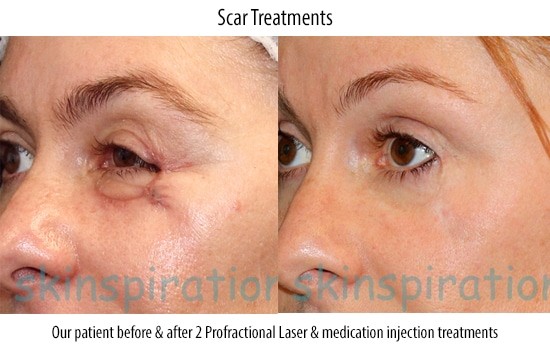 Scar Treatment Results
