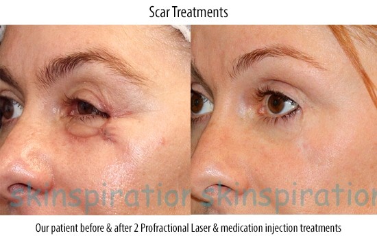 Before &amp; after photos of a Skinspirations patient&#039;s results with laser scar treatments.