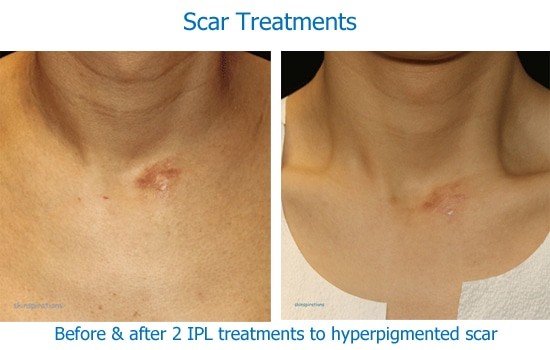 Scar Treatment Results