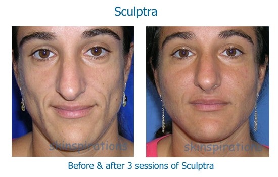 Before and after Sculptra treatments at Skinspirations in Clearwater FL