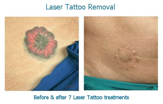 Laser Tattoo Removal Results