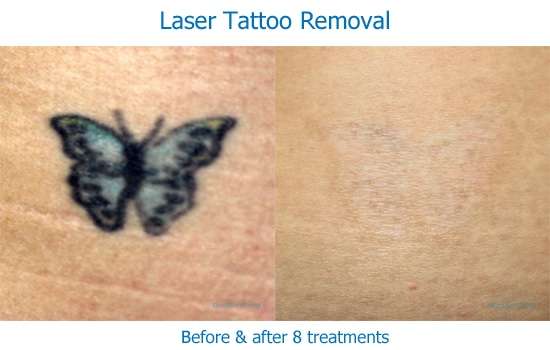 A colored butterfly tattoo before and after laser removal