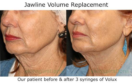 Jawline tightening with Volux filler at Skinspirations in Clearwater, FL