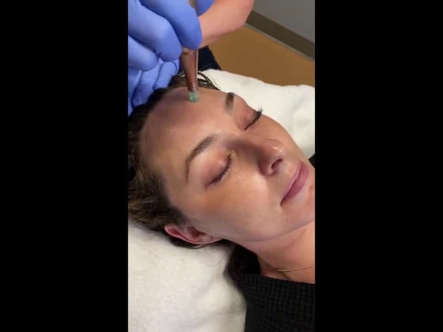Nanoneedling Reduces Pore Size &amp; Stimulates Collagen