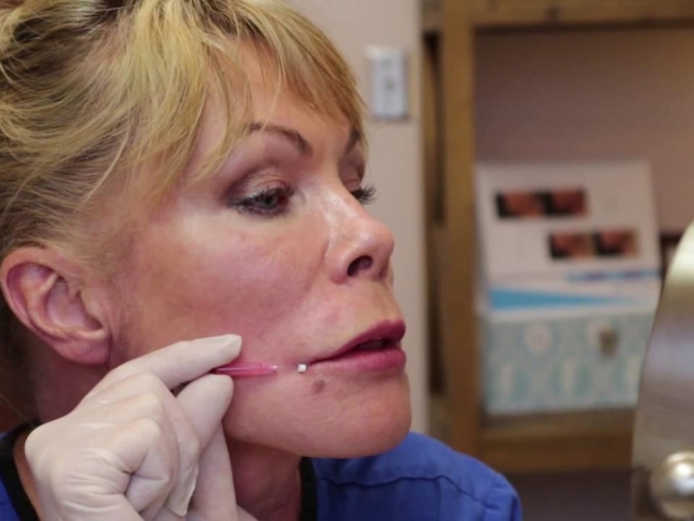 A demonstration of absorbable face threads to define the lips